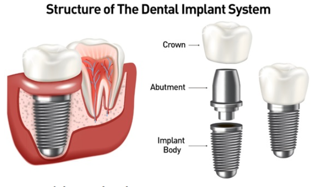 dental implant structure