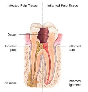 dental implant structure